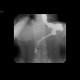 Duodenal stent, migration of stent: RF - Fluoroscopy